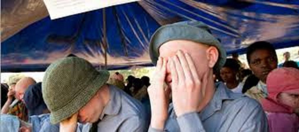 13 juin, journée mondiale de sensibilisation à l’albinisme : Que de cruautés, et de superstitions à leur égard !