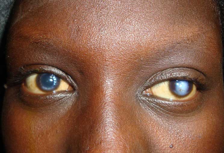 Ziguinchor – La cécité au Sénégal : Des chiffres qui font froid dans le dos