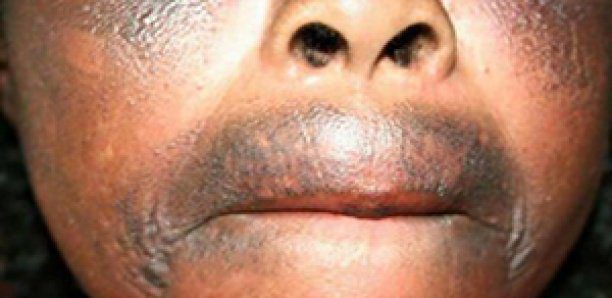 Dépigmentation : Le taux et les ravages au Sénégal sont inquiétants