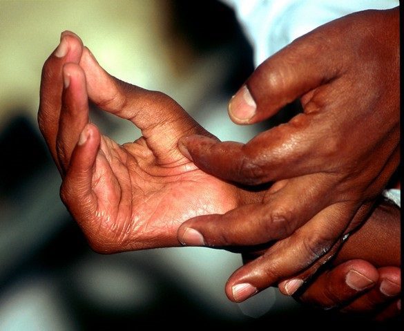Lèpre : 56% des personnes nouvellement infectées ont moins de 15 ans