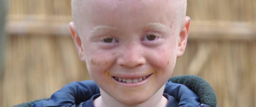 13 juin – Journée internationale des Albinos : L’albinisme, une maladie toujours mal perçue en Afrique