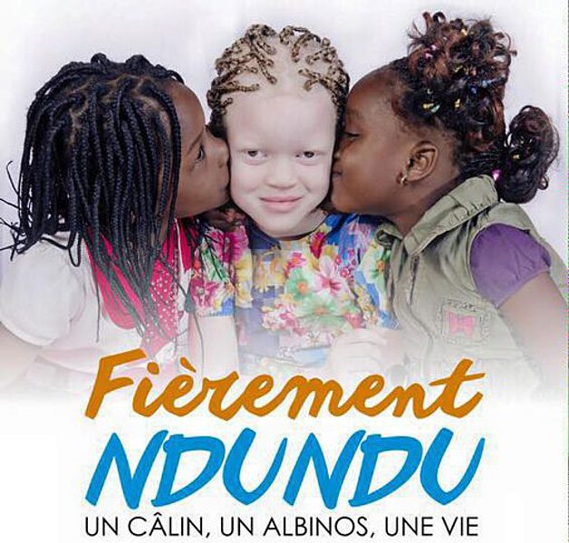 Journée de l’Albinisme : Le président de l’Association des albinos dénonce la lenteur des autorités dans la prise en charge de leurs préoccupations