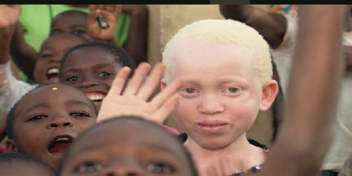 Social : Un centre d’accueil des albinos accueilli à Thiès
