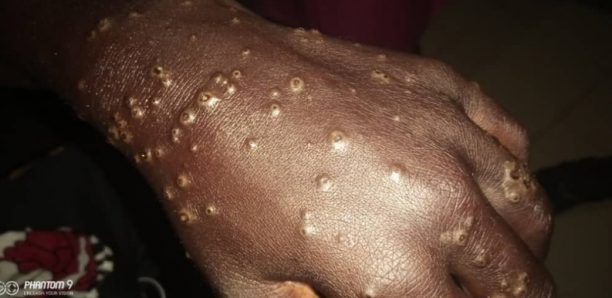 Thiaroye Sur-Mer : Une mystérieuse maladie touche les pécheurs