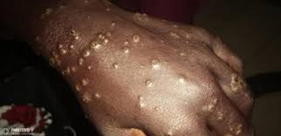 Dermatoses chez des pêcheurs : Plus de 300 cas recensés (L’infirmier-chef de Poste (ICP) de Thiaroye-Sur-Mer)