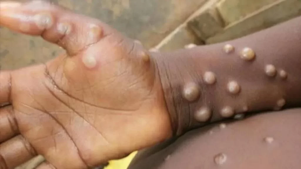 Variole du singe : L’Afrique de plus en plus touché (OMS)