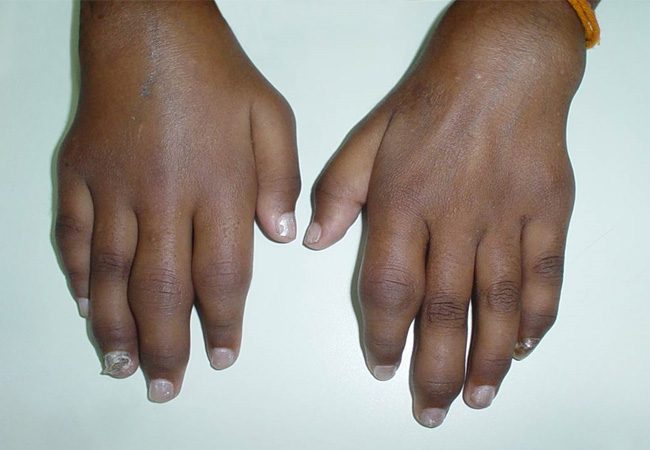 Epidémie d’arbre virose de chikungunya : 44 cas recensés à Kédougou et Saraya